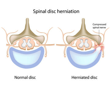 herniated-disk