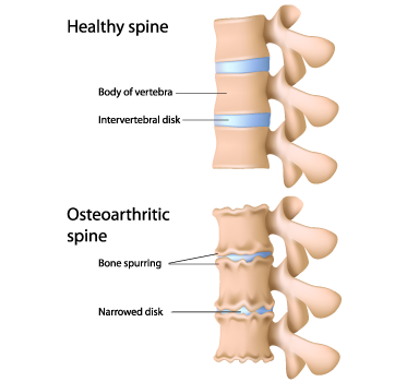 osteoarthritis